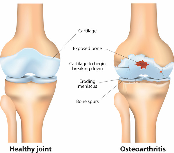 Healthy Joint vs Osteoarthritis